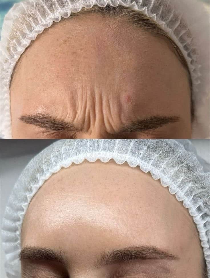 أضرار البوتكس