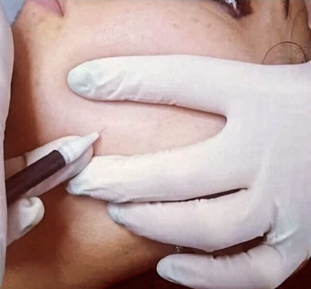 إزالة الشعر بالإلكتروليسيس باستخدام إبرة دقيقة داخل بصيلة الشعر